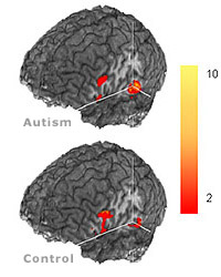 autism brains